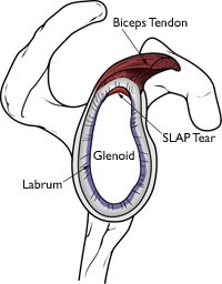 SLAP tear shoulder anatomoy